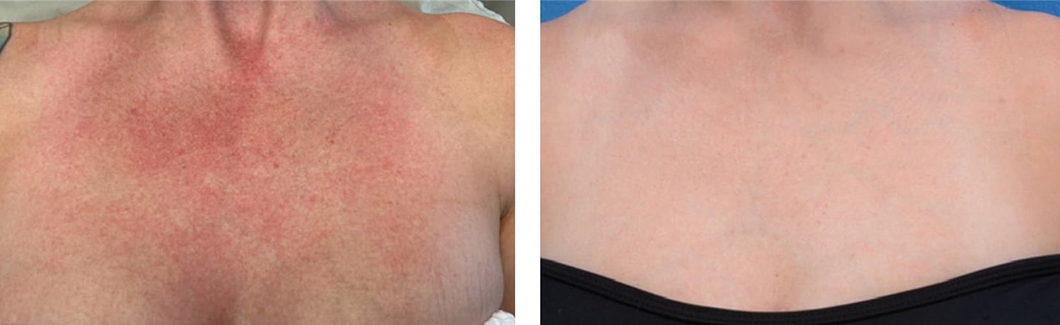 Before and after skin treatment comparison.