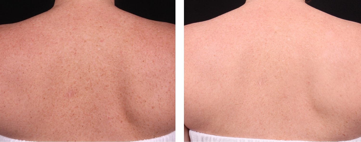 Before and after skin treatment comparison on back.