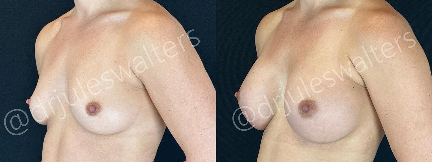 Side-by-side comparison of breast appearance.