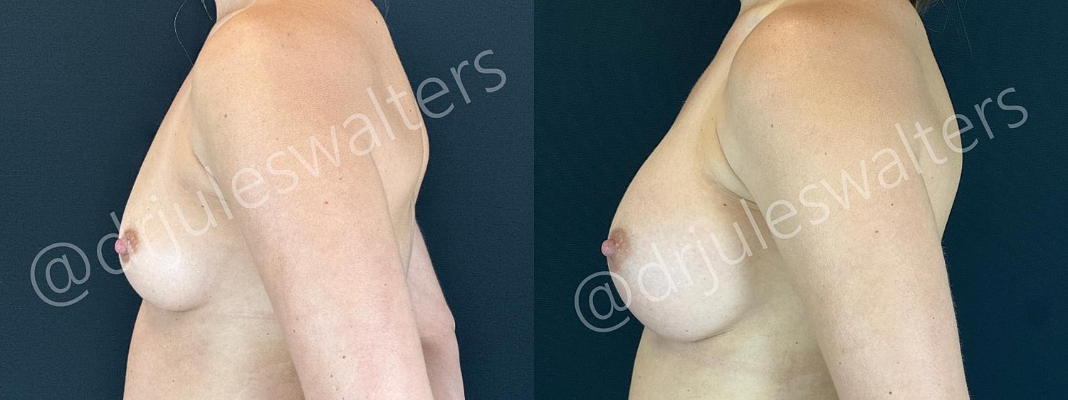 Before and after breast augmentation comparison image.