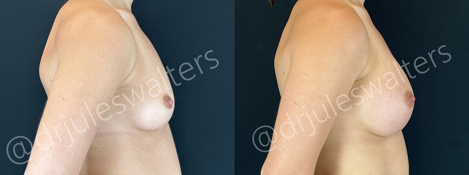 Before and after body contouring procedure.