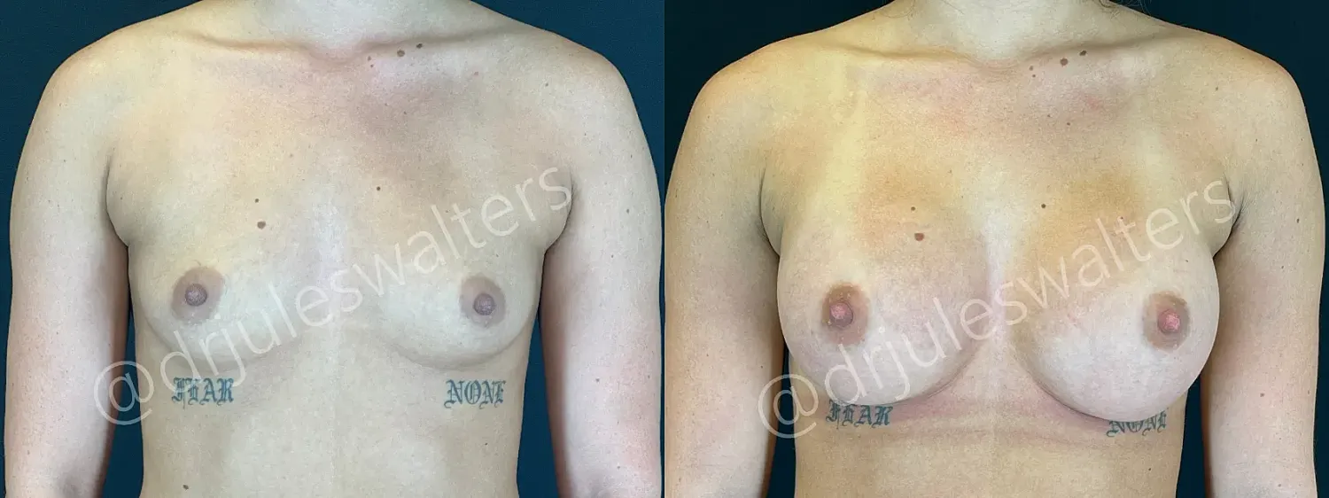 Before and after breast augmentation comparison photos.