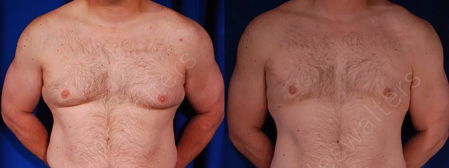 Before and after chest comparison, male torso.