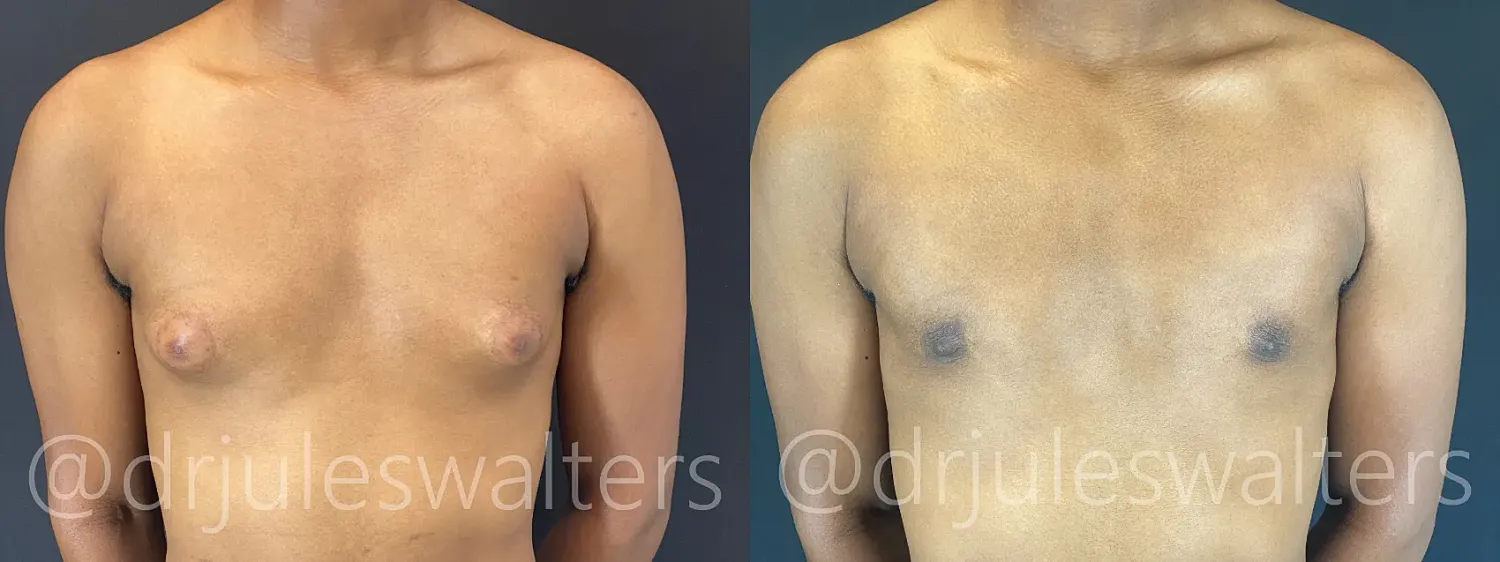 Before and after chest transformation comparison.