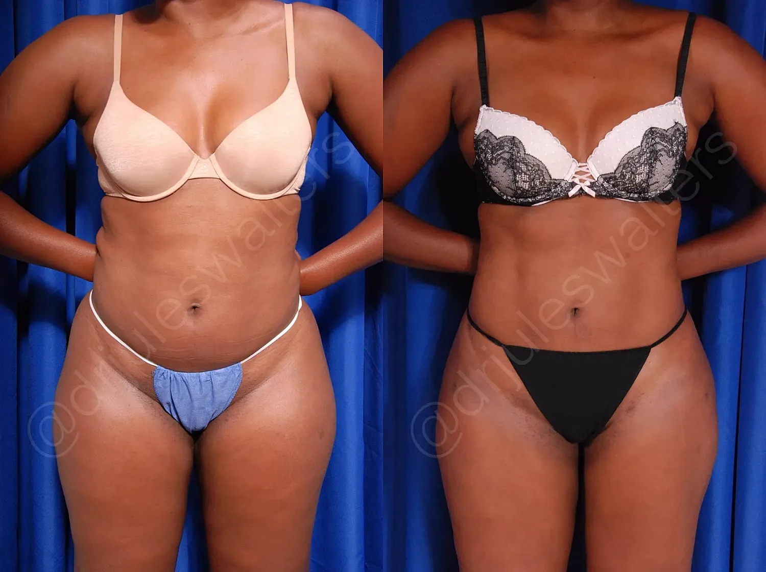 Before and after lingerie fit comparison.
