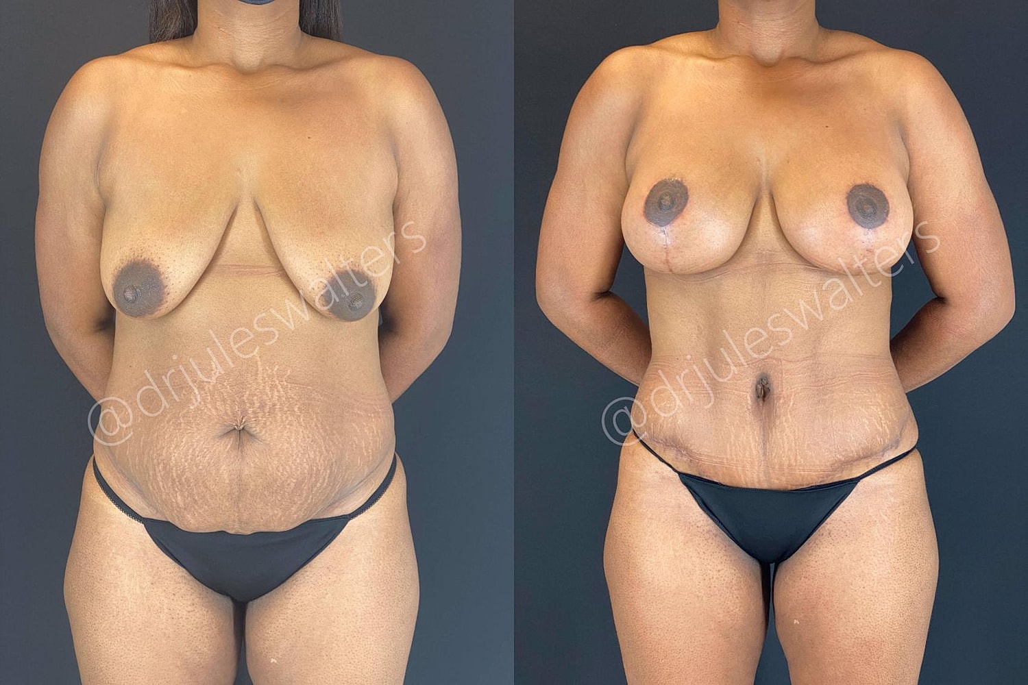 Before and after body transformation photo.