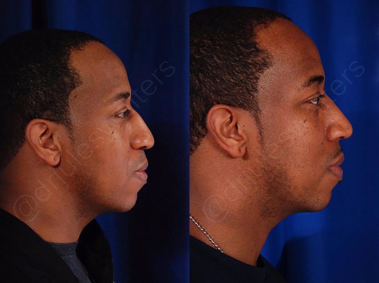 Side profile comparison of a person's face.