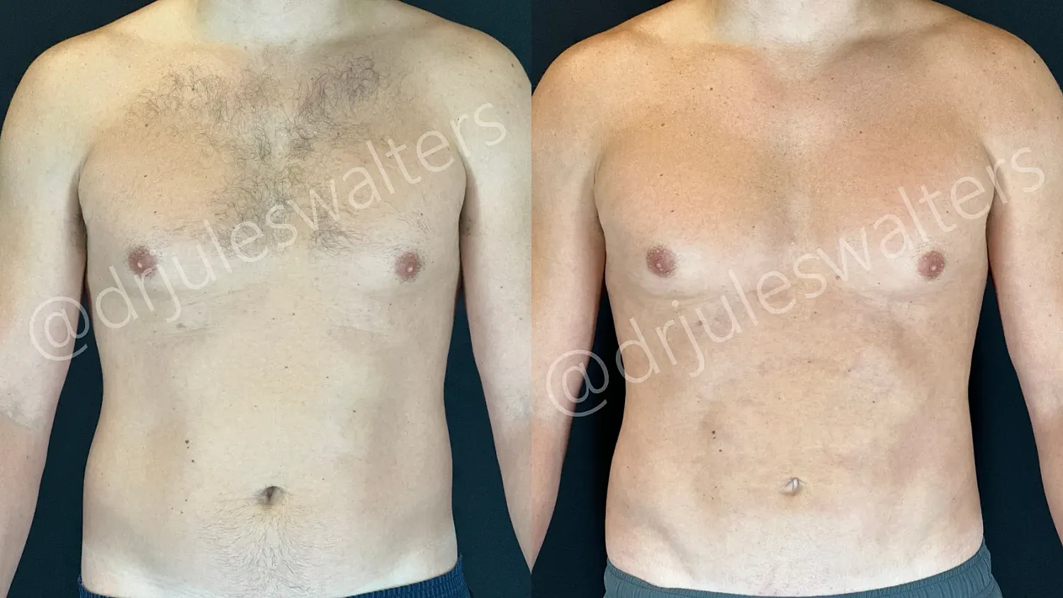 Before and after body hair removal comparison.