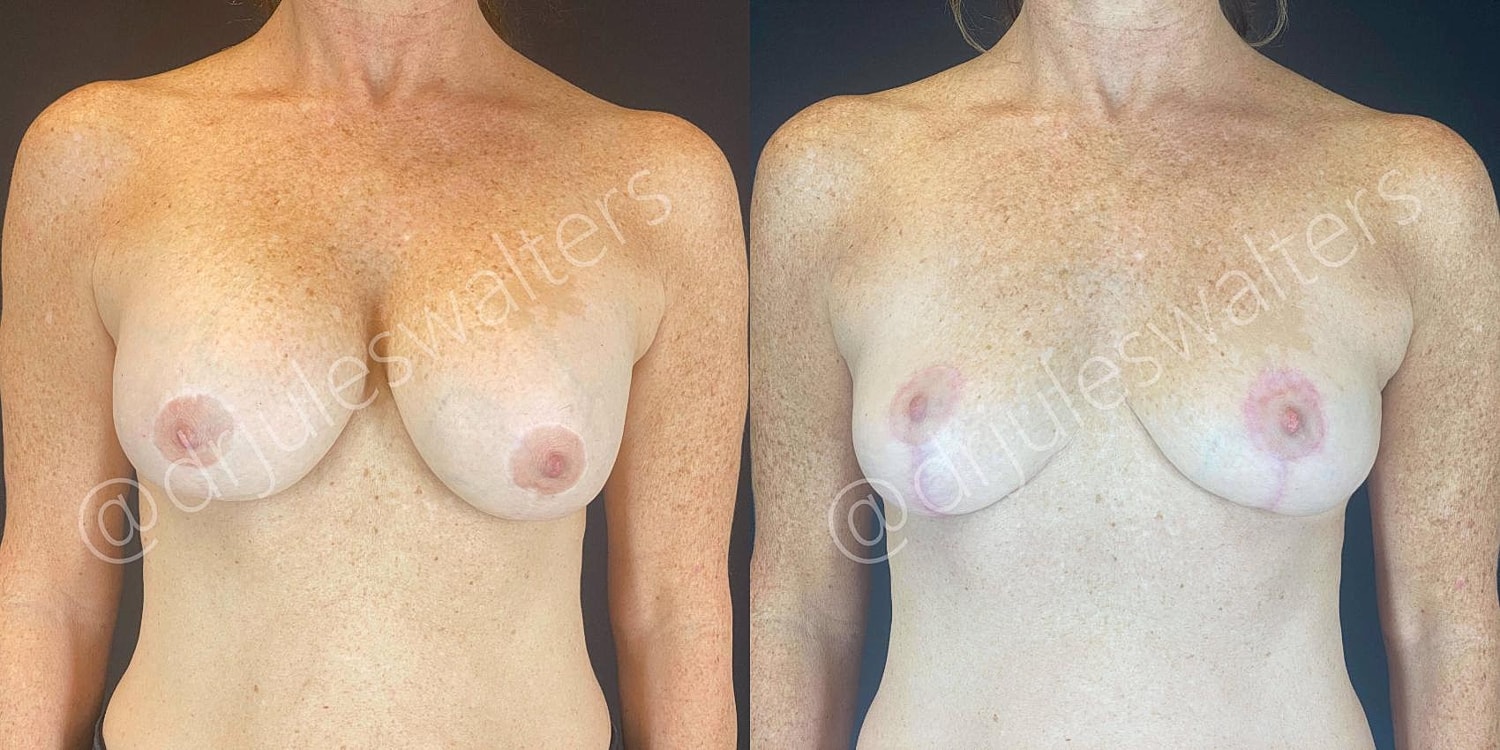 Breast Revision Before & After