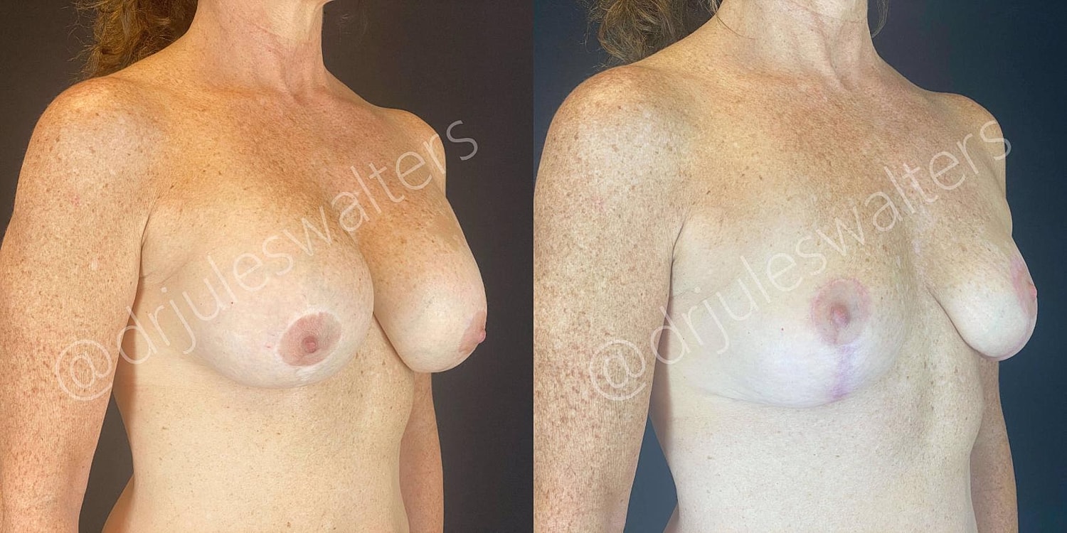 Breast Revision Before & After