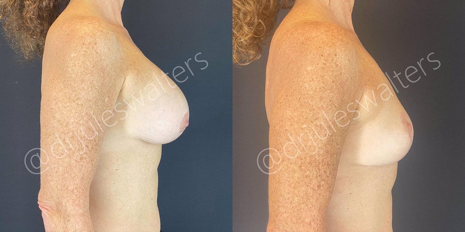 Breast Revision Before & After