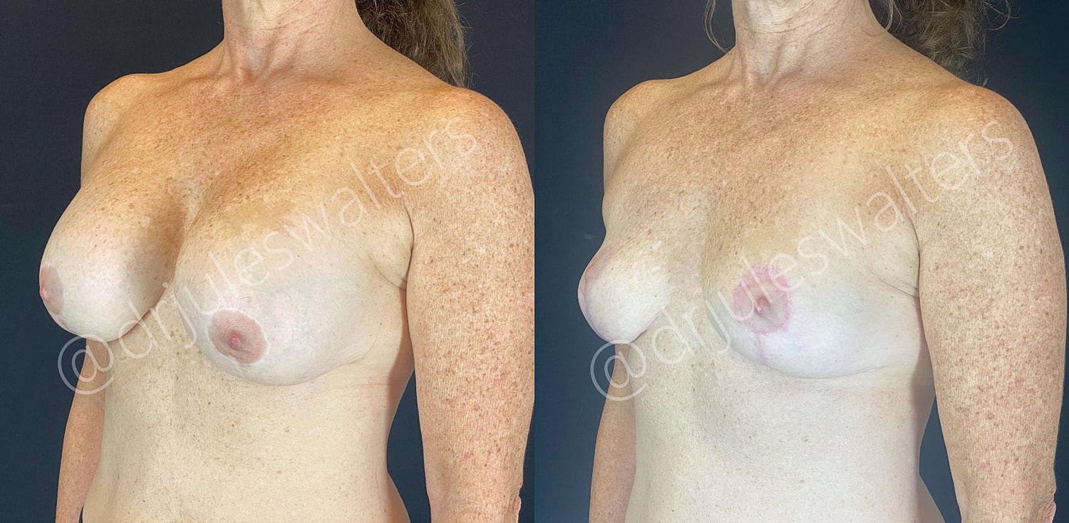 Breast Revision Before & After