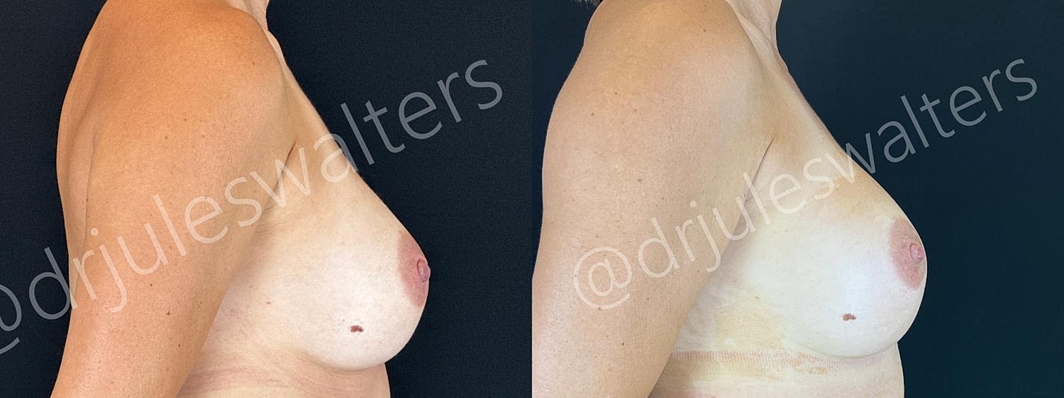 Breast Revision Before & After