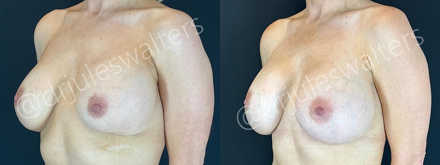 Breast Revision Before & After