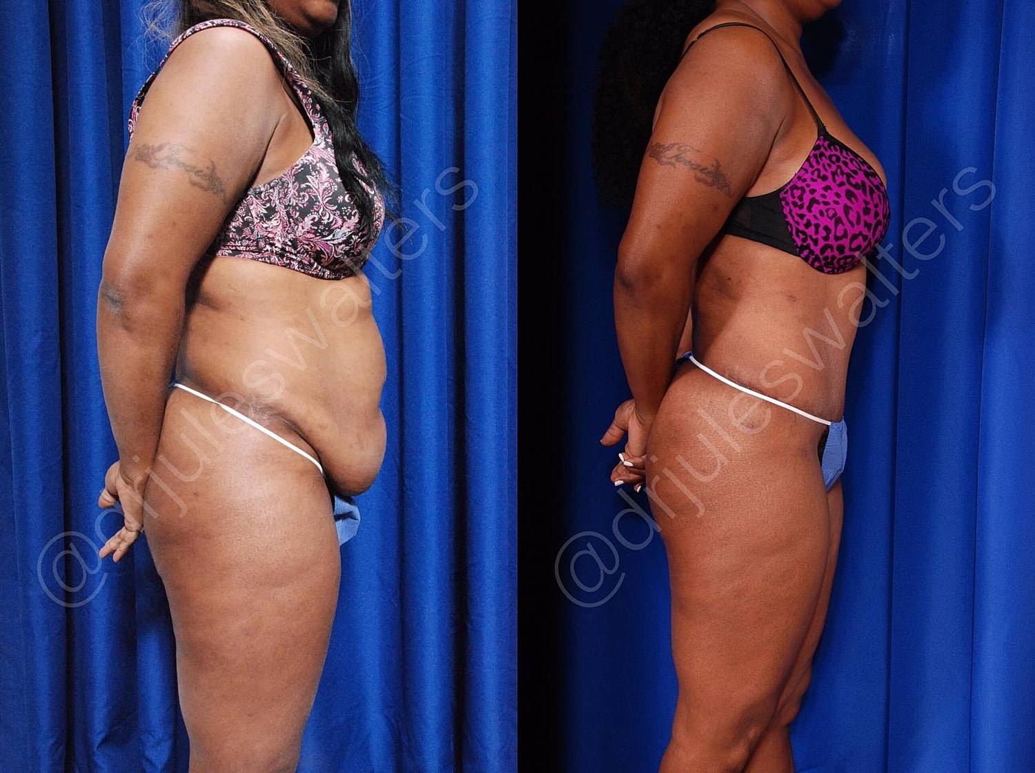 Liposuction Before & After