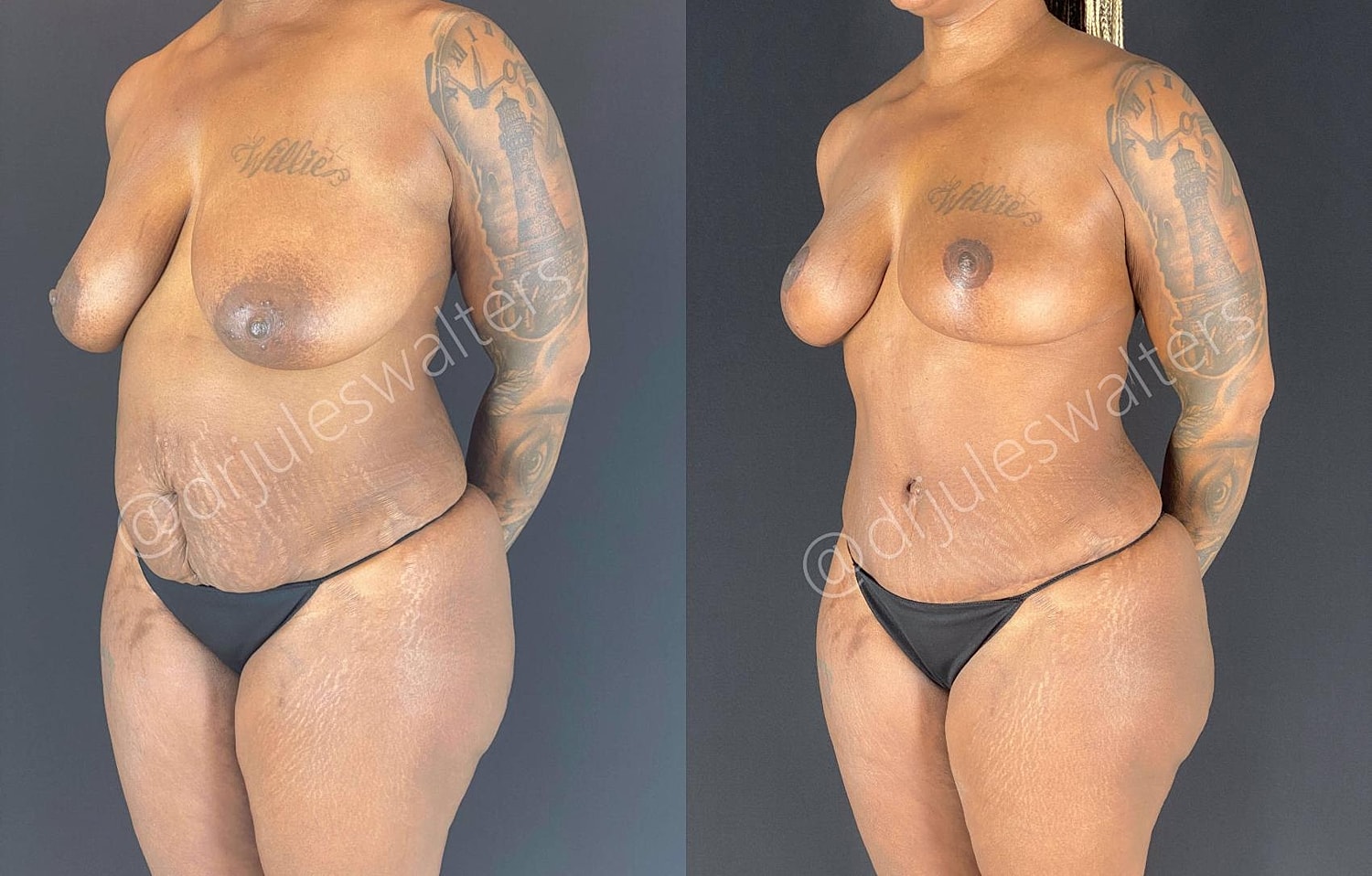 Liposuction Before & After