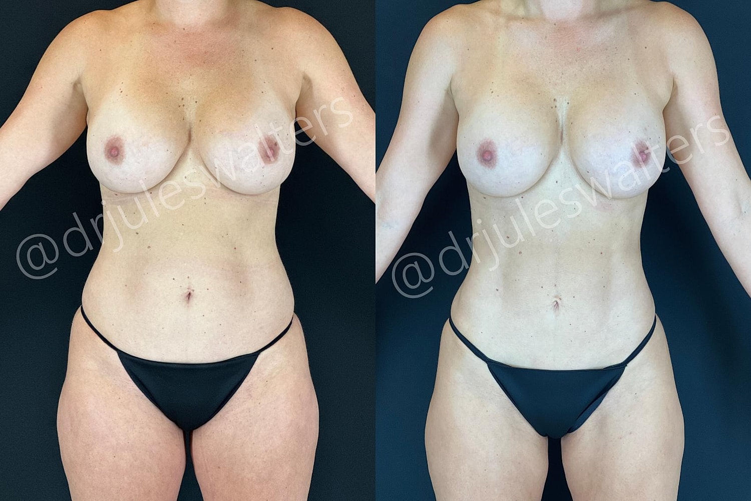 Liposuction Before & After