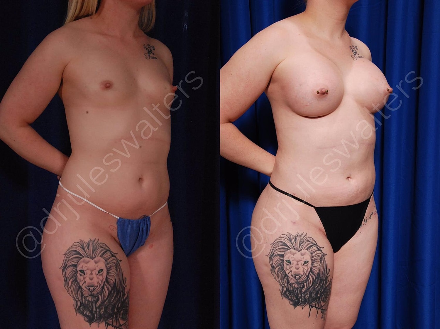 Liposuction Before & After