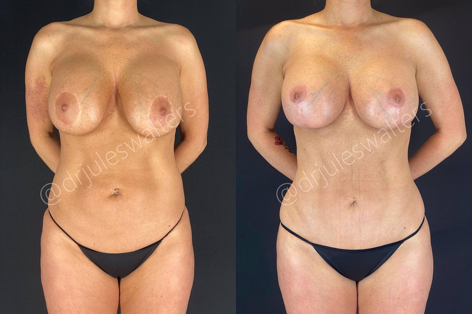 Liposuction Before & After