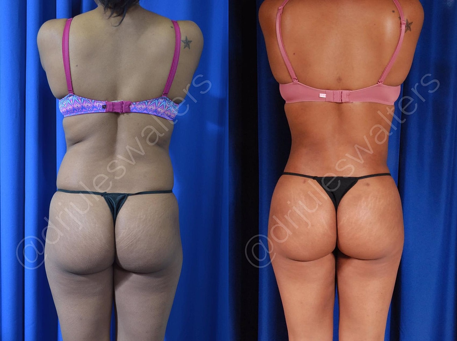 Liposuction Before & After