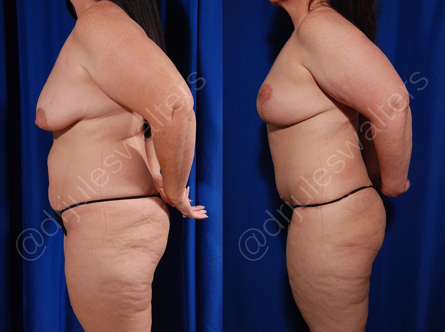 Liposuction Before & After