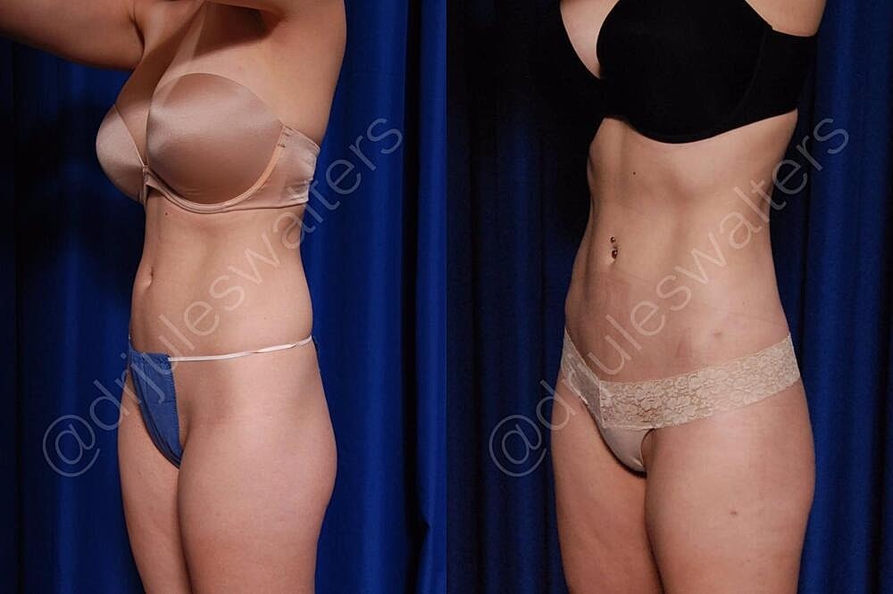 Liposuction Before & After