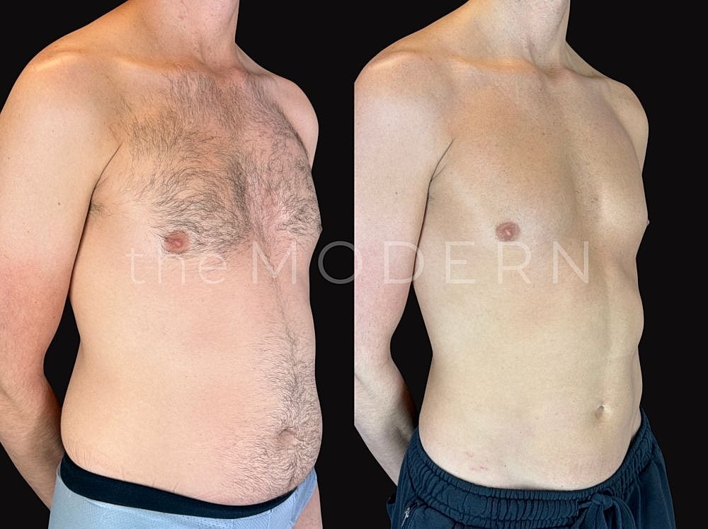 Before and after body transformation comparison.