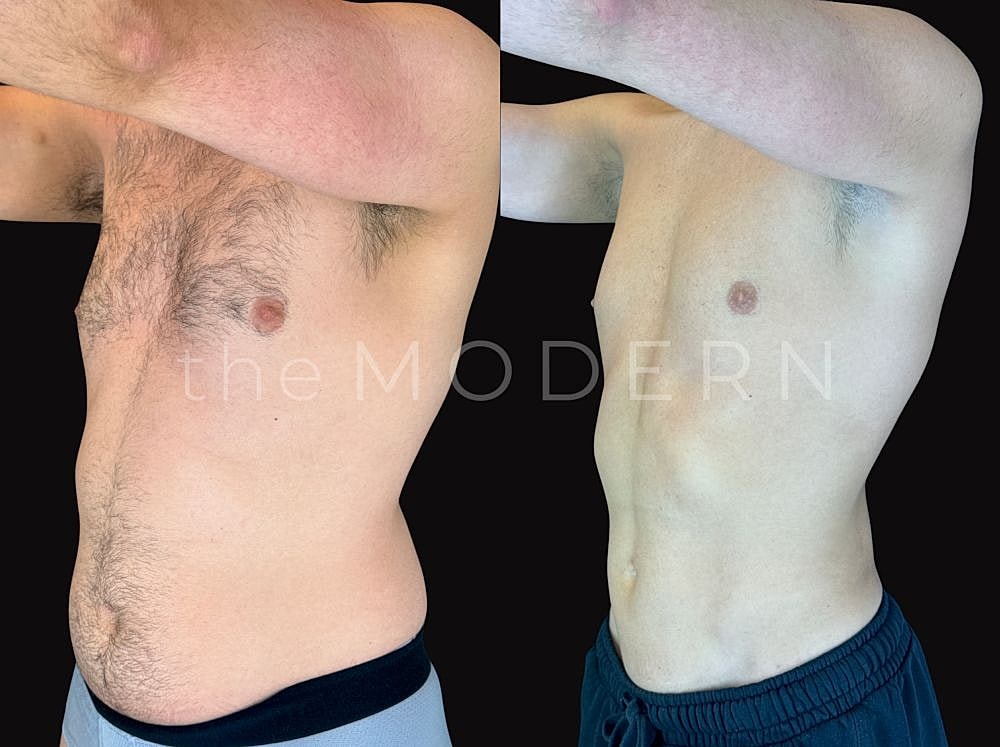 Before and after body transformation photo comparison.