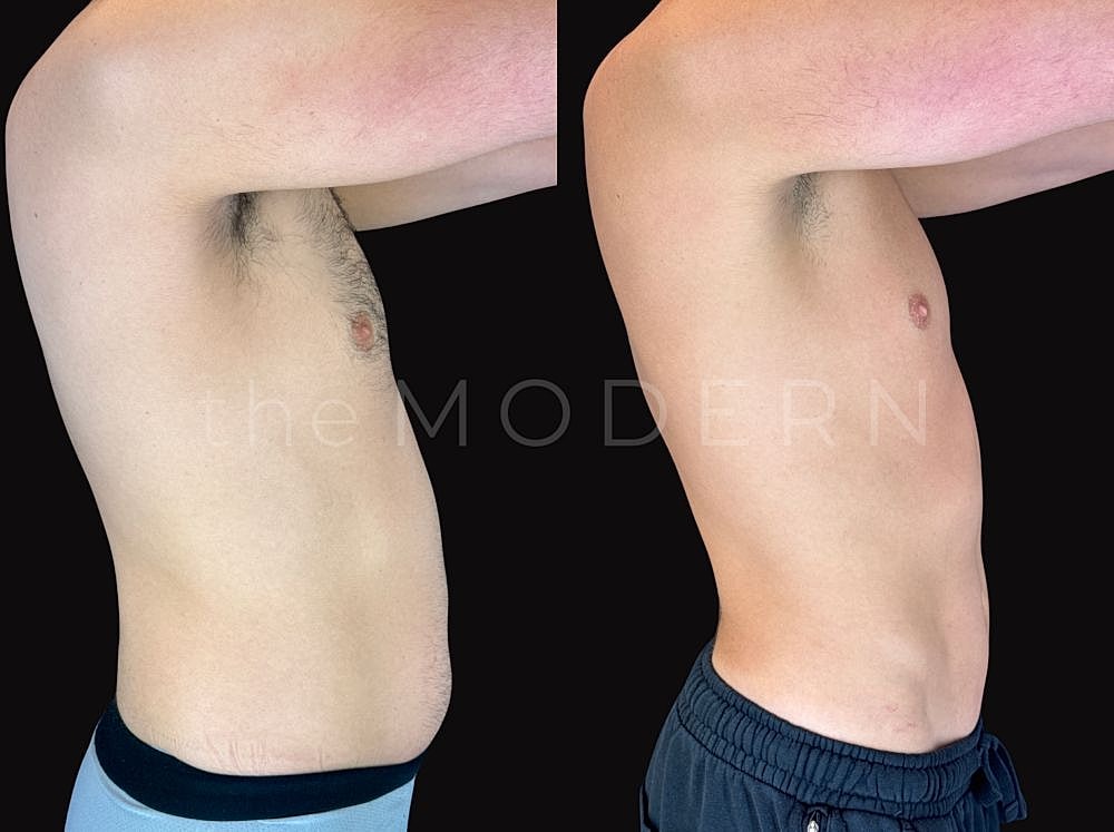 Before and after body transformation comparison.