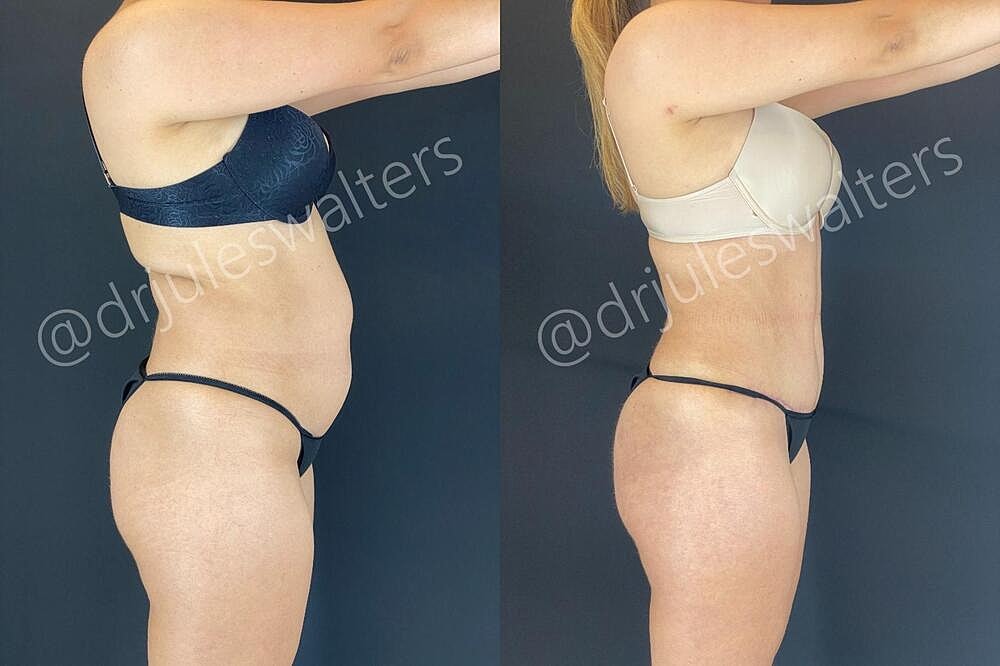 Liposuction Before & After