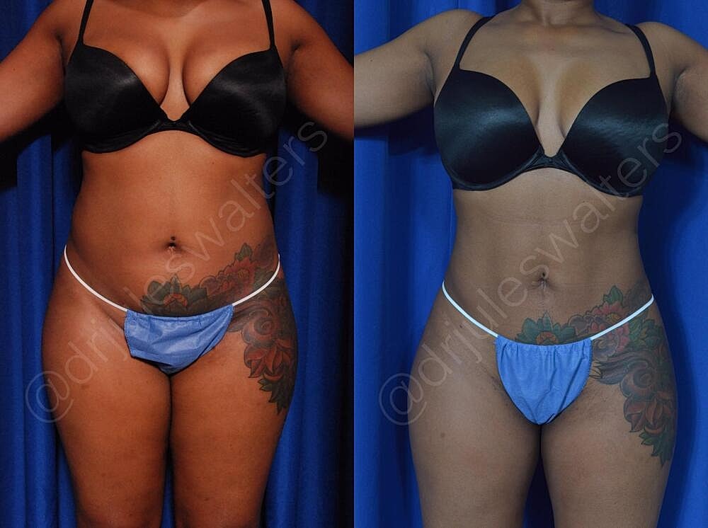 Liposuction Before & After