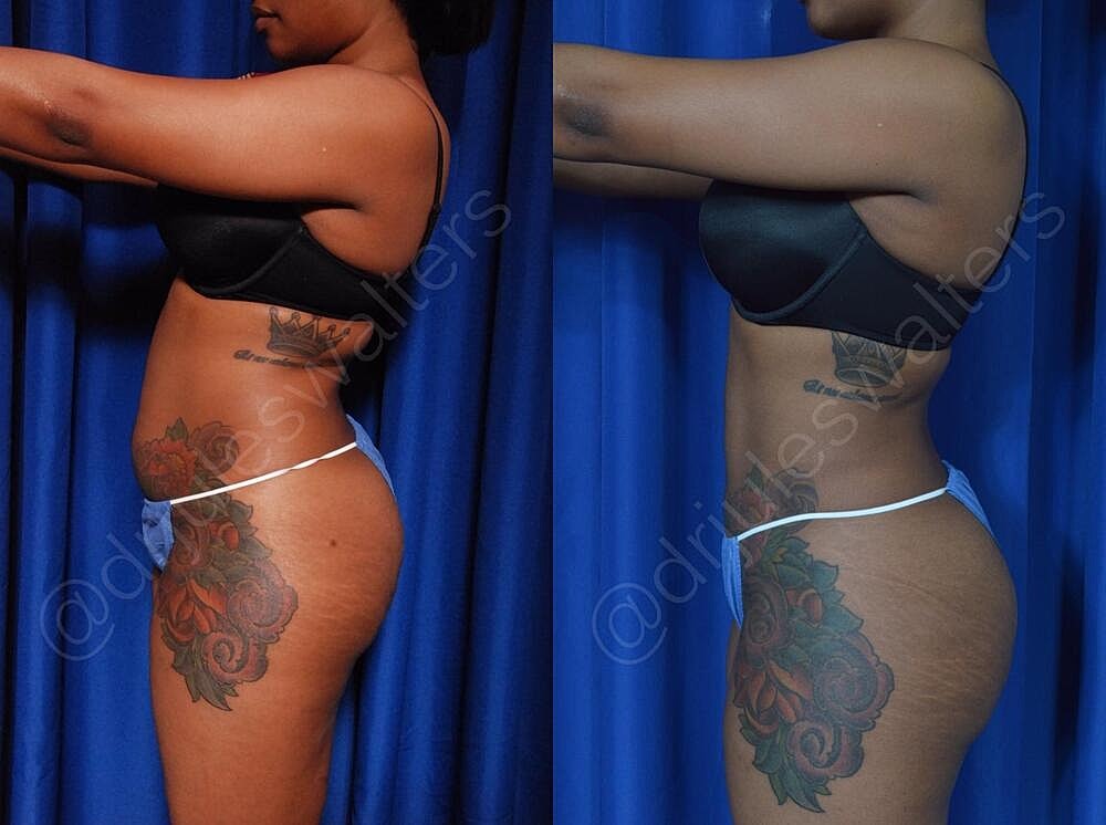 Liposuction Before & After