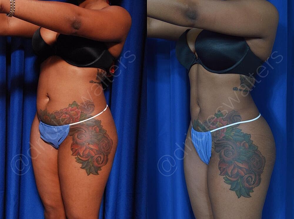 Liposuction Before & After