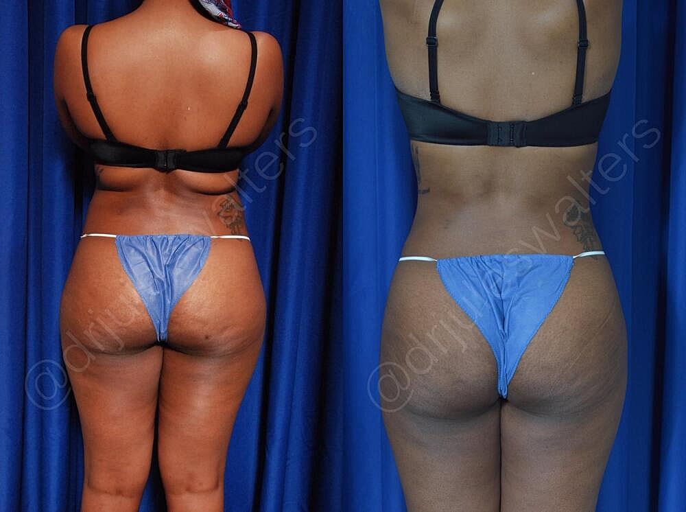 Liposuction Before & After