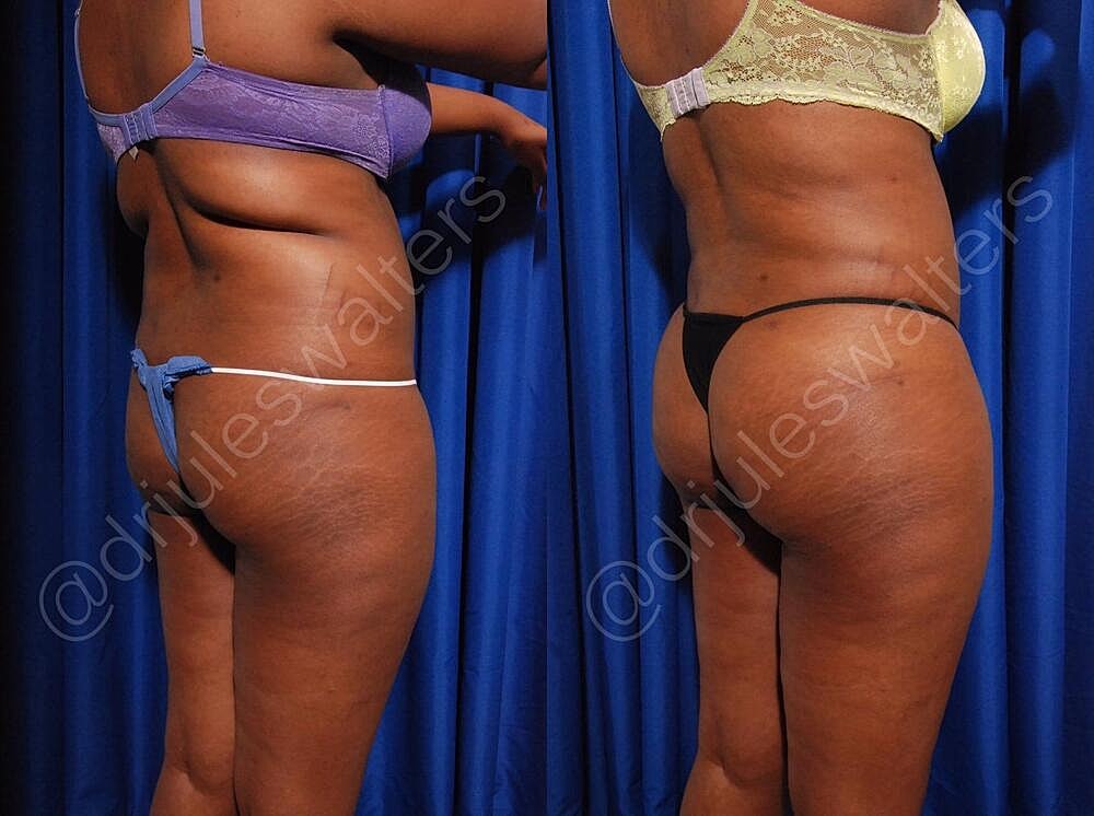 Liposuction Before & After