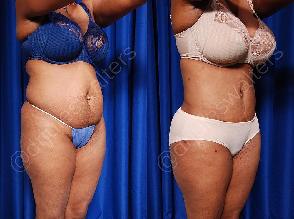 Liposuction Before & After