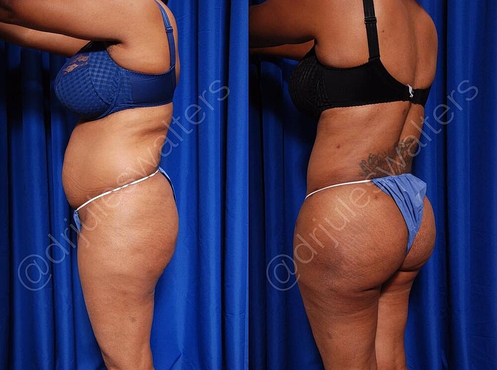 Liposuction Before & After