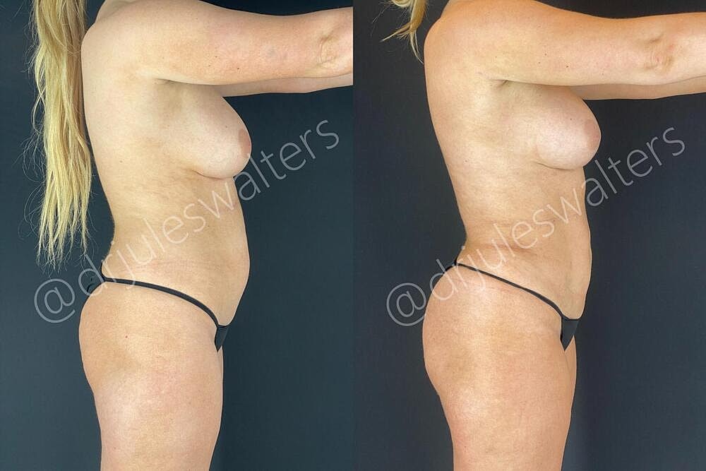 Liposuction Before & After