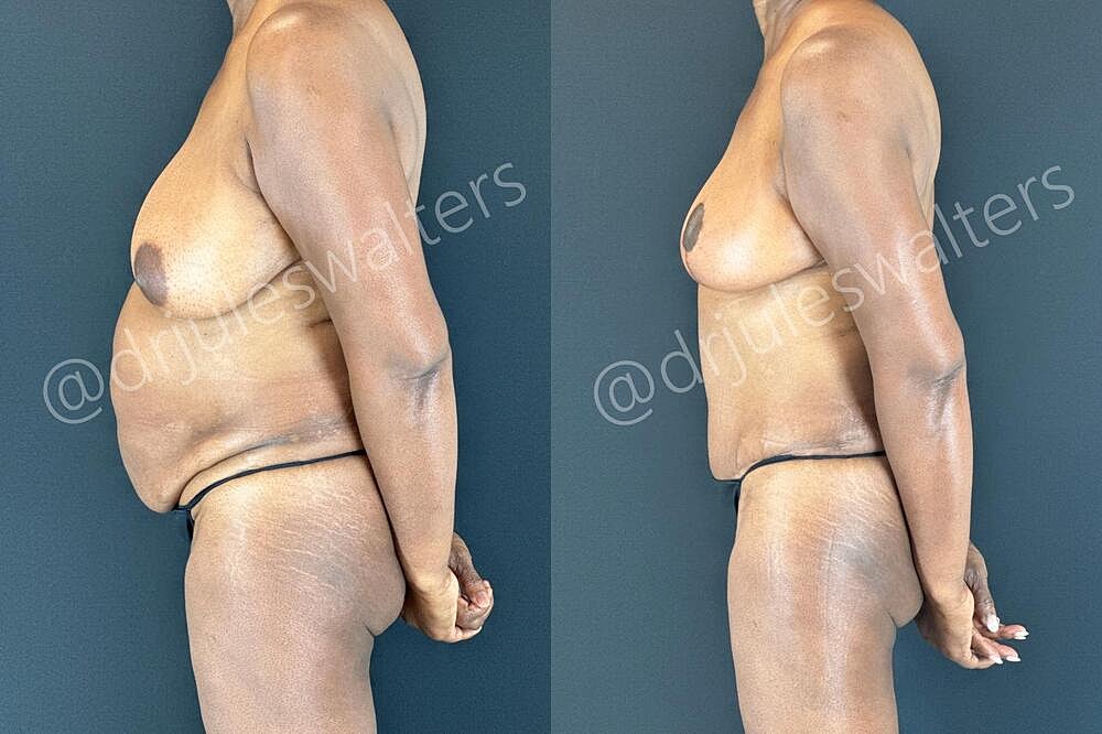 Liposuction Before & After