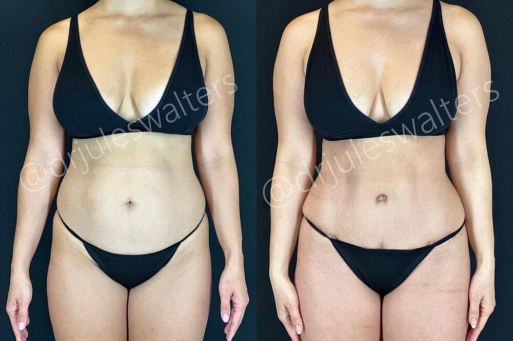 Liposuction Before & After