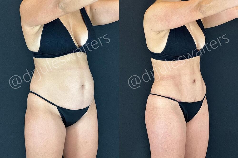 Liposuction Before & After