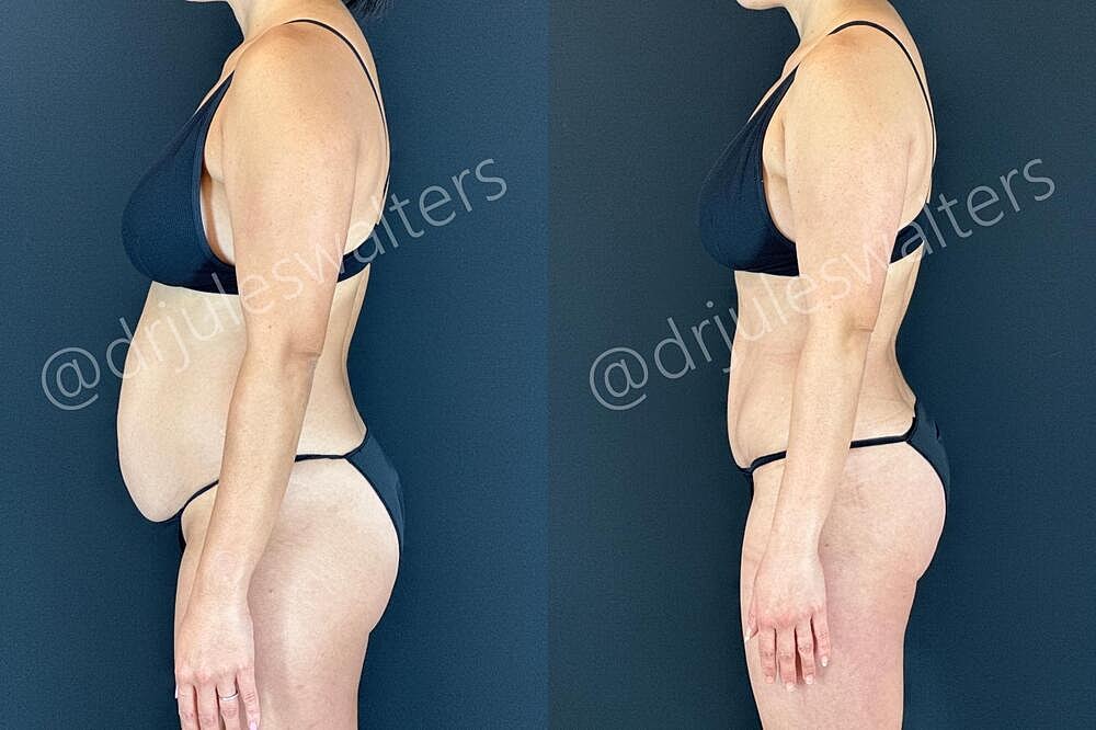 Liposuction Before & After