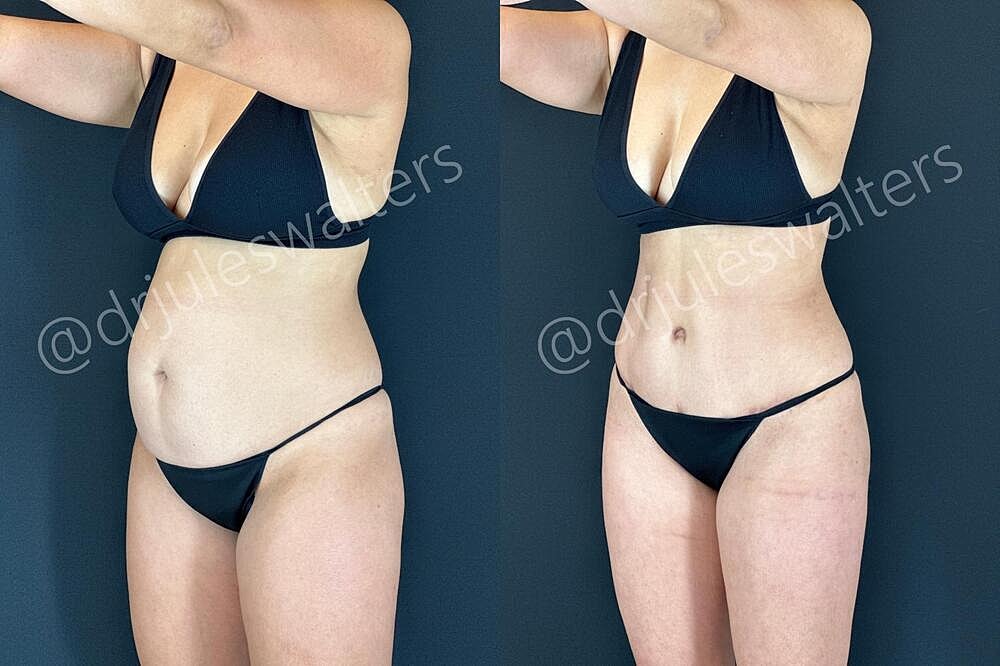 Liposuction Before & After