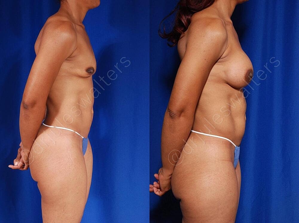 Liposuction Before & After