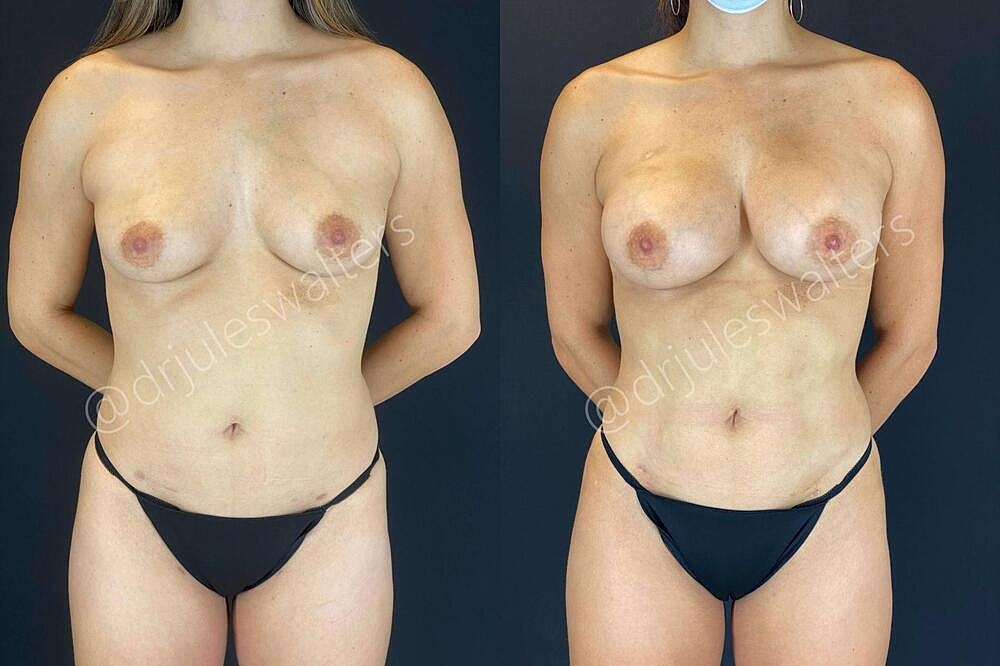 Liposuction Before & After
