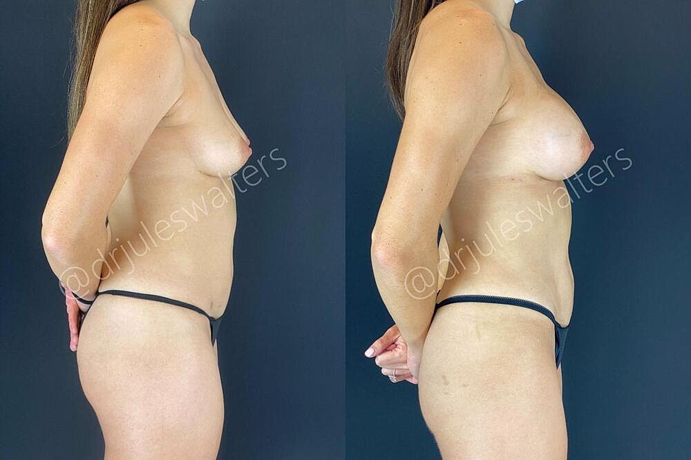 Liposuction Before & After