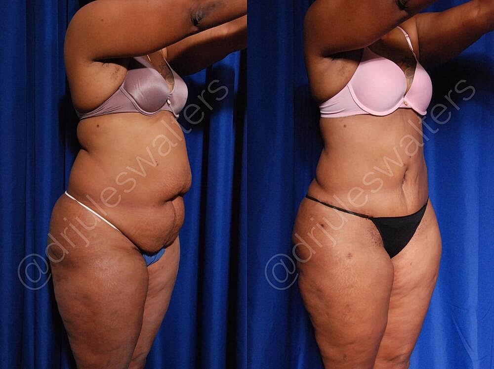 Liposuction Before & After