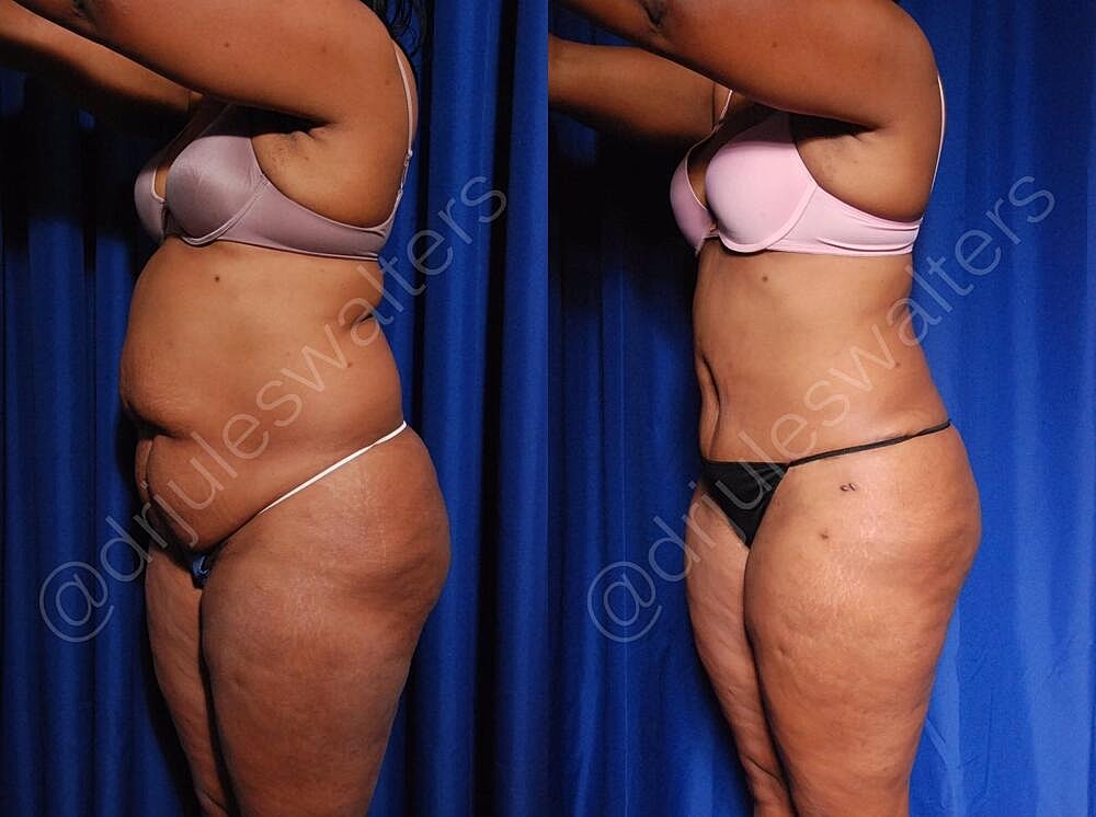 Liposuction Before & After