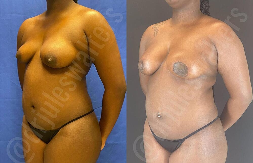 Liposuction Before & After