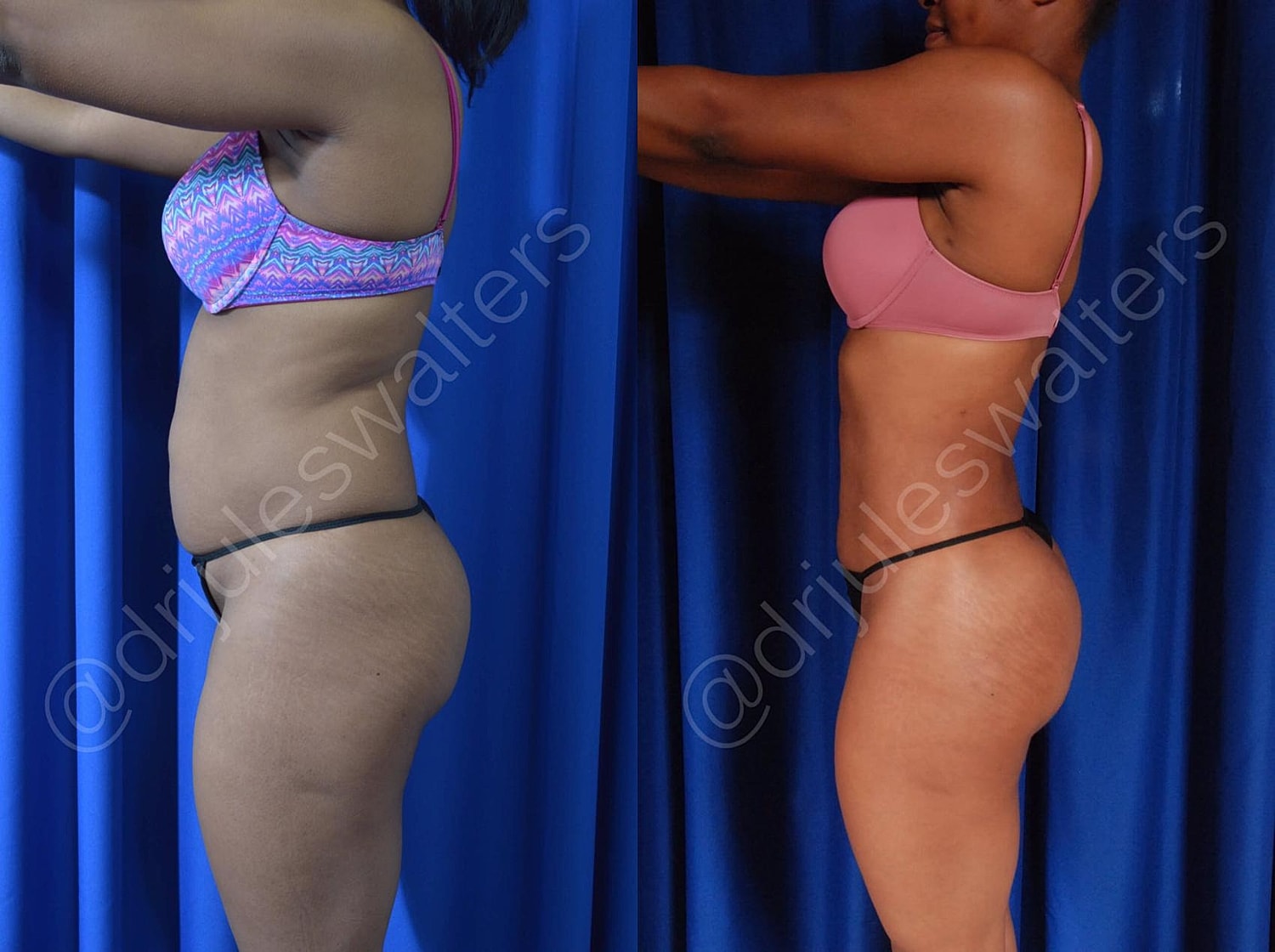 Brazilian Butt Lift Before & After